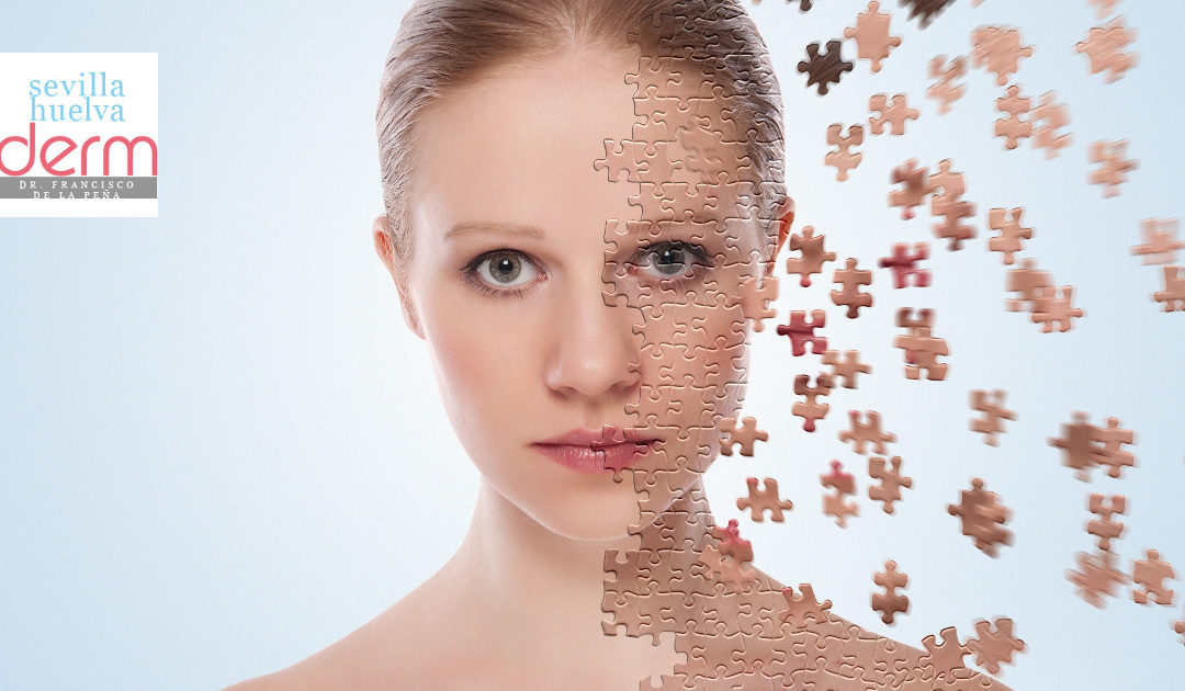 Cicatrices atróficas y marcas de acné; cómo tratarlas