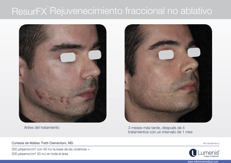 Eliminacion marcas de acné con resurfx en Córdoba