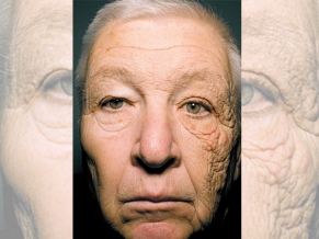 Camionero que durante 30 años expuso su lado izquierdo más a la radiación solar ha sufrido envejecimiento prematuro en este lado de la cara.