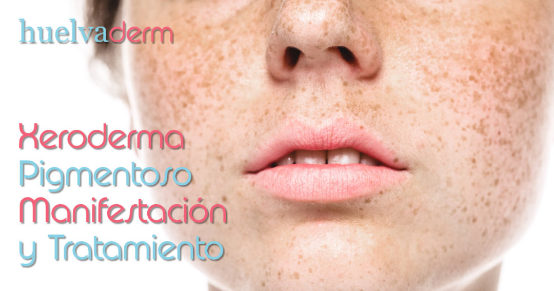 Xeroderma pigmentoso: manifestación y tratamiento
