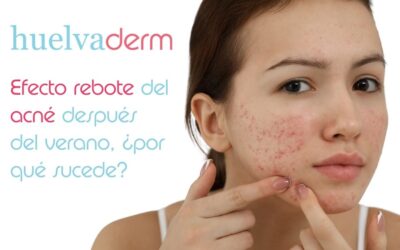 Efecto rebote del acné después del verano, ¿por qué sucede?