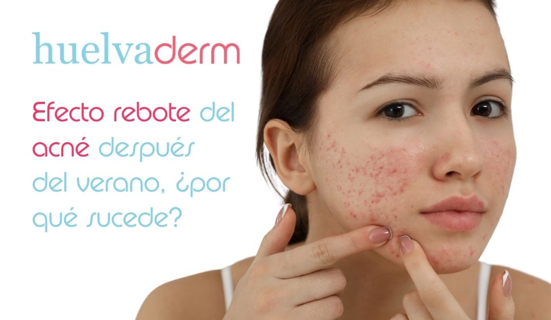 Efecto rebote del acné después del verano, ¿por qué sucede?