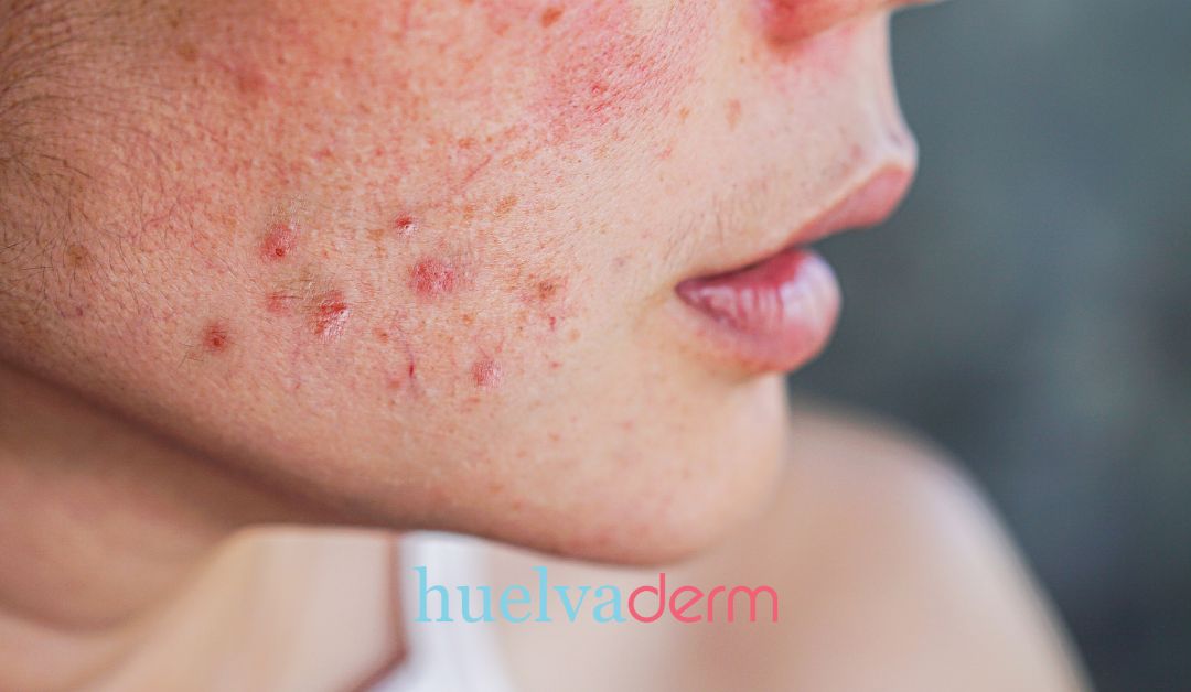 El síndrome SAHA y el acné