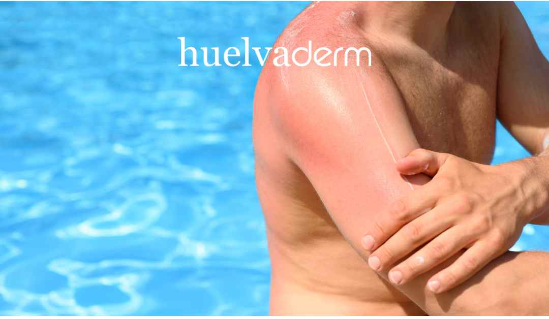 consecuencias del exceso solar